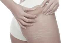 Bodifix: New Mesotherapy approach for Stretch Marks